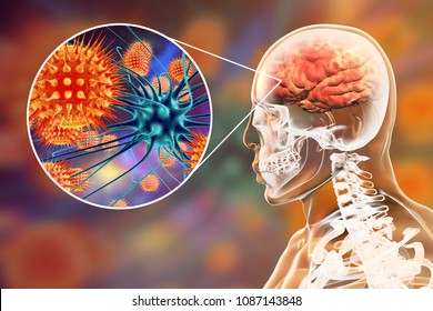 Viral Meningitis And Encephalitis, Medical Concept, 3D Illustration Showing Brain Infection And Close-up View Of Viruses In The Brain