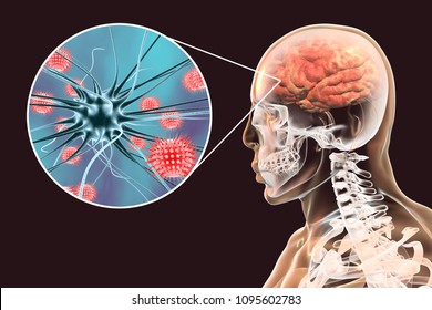 Viral Meningitis And Encephalitis, Medical Concept, 3D Illustration Showing Brain Infection And Close-up View Of Viruses In The Brain