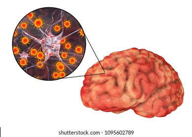 Viral Meningitis And Encephalitis, Medical Concept, 3D Illustration Showing Brain Infection And Close-up View Of Viruses In The Brain