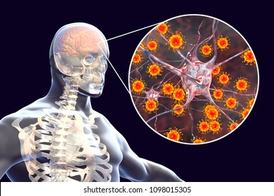 Viral Meningitis And Encephalitis, Medical Concept, 3D Illustration Showing Brain Infection And Close-up View Of Viruses In The Brain