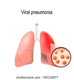 Viral Pneumonia. Normal And Inflammatory Condition Of  Human Lungs. Viruses That Cause Disease