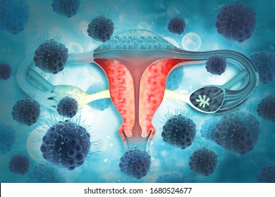 Virus Or Bacteria Infected Female Reproductive System, Uterine Diseases Concept, Uterus Cancer, 3d Illustration