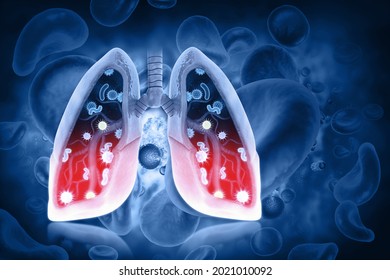 Virus And Bacteria Infected The Human Lungs, Lung Disease, 3d Illustration