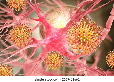 Viruses And Neurons, Neurons In Alzheimer's Diseas, Neurofibrillary Tangles And Distruction Of Neuronal Networks, 3d Illustration