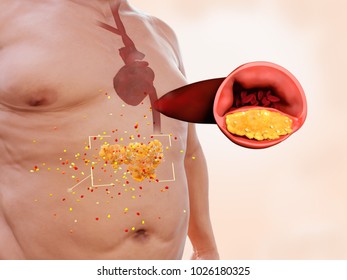 Visceral fat is highly hormonally active. It raises the LDL-level in the blood causing a higher risk of atherosclerosis and stroke. 3d rendering.