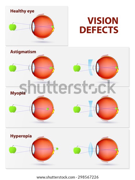 Vision Disorders Astigmatism Myopia Hyperopia Stock Illustration 298567226