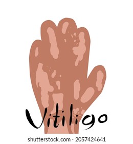 Vitiligo Skin Disease On The Arm. White Spots On The Skin. Raster Illustration With Lettering.