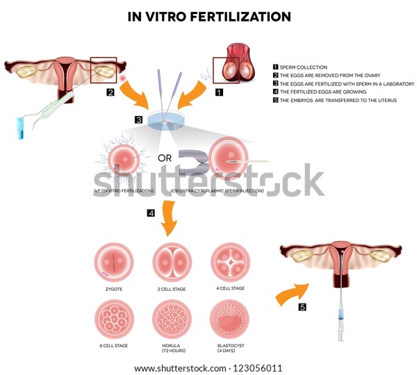 Vitro Fertilization Detailed Illustrations Showing Egg Stock ...