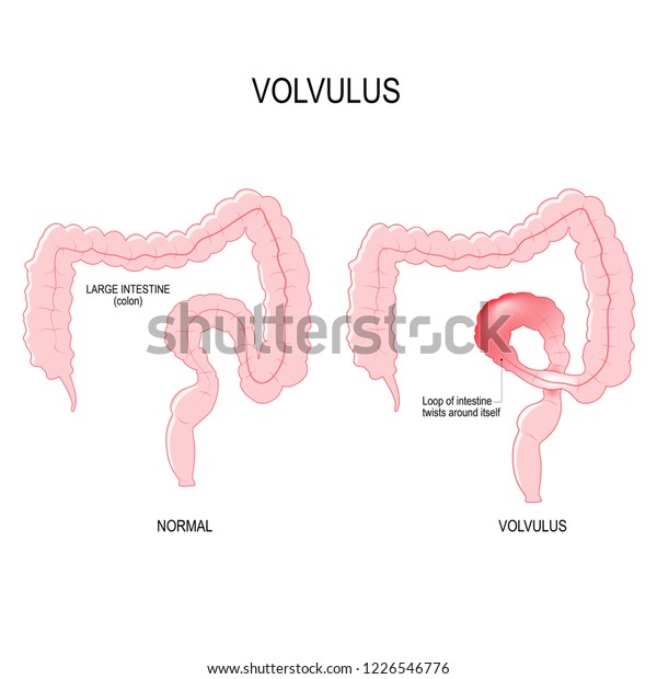 Volvulus Loop Intestine Twists Around Itself Stock Illustration 1226546776