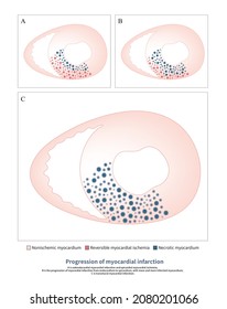 When Acute Myocardial Infarction Occurs, Myocardial Necrosis Advances From Endocardium To Epicardium Until The Infarction Penetrates The Wall.