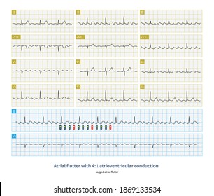 255 Atrial flutter Images, Stock Photos & Vectors | Shutterstock