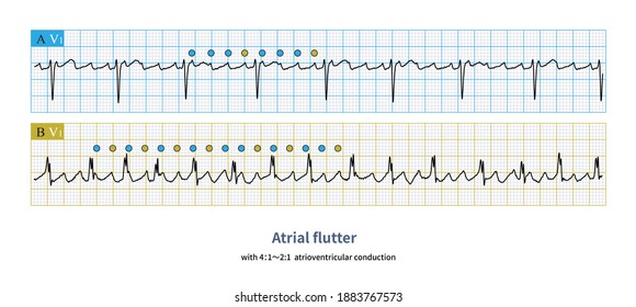 When atrial flutter is accompanied by different proportion of atrioventricular conduction, the ventricular rate becomes irregular, which needs to be differentiated from atrial fibrillation.