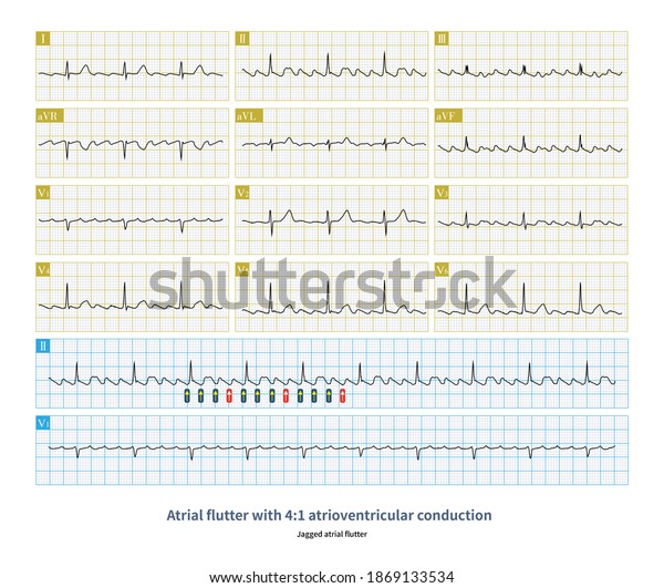 When Atrial Flutter Accompanied By 4 Stock Illustration 1869133534 ...