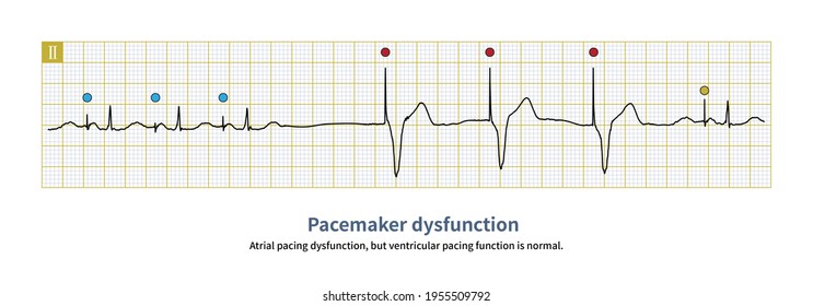 When dual chamber pacemaker fails, complex pacemaker ECG can be formed by single atrial pacing disorder, single ventricular pacing disorder, or atrial and ventricular pacing disorder.