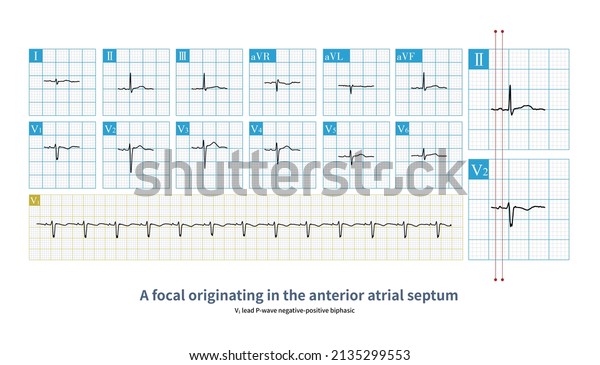 6 P Wave Biphasic Images, Stock Photos & Vectors | Shutterstock