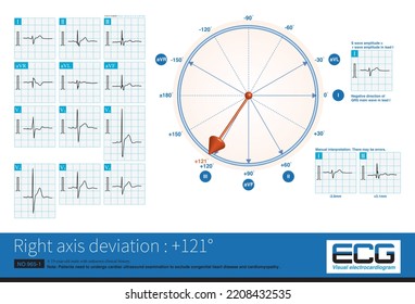 When The Electrical Axis Deviates To The Right, The Maximum QRS Vector Is Located In The Lower Right Quadrant, Which Can Be Interpreted In Combination With The QRS Wave Characteristics Of Limb Leads.