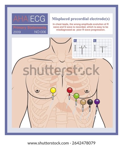 When the electrodes in the chest lead are placed incorrectly, the wrong amplitude evolution of R wave and S wave will occur, which is easy to be misdiagnosed as poor increase of R wave or old AMI.
