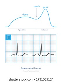 When Impulse Is Blocked From Right Atrium To Left Atrium, That Is Bachamann Bundle Block, There Will Be A Special Dome Peak P Wave.