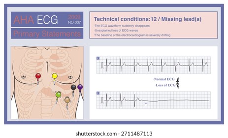 When the leads of the electrocardiogram fall off, most often in the chest leads, the ECG waves in that lead may suddenly disappear. Do not misdiagnose this as cardiac arrest.