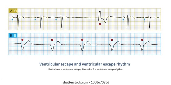 30 Ventricular Escape Images, Stock Photos & Vectors | Shutterstock