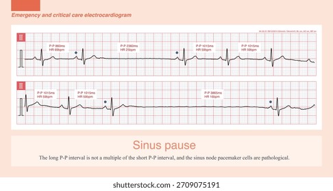 When the pacemaker cells of sinoatrial node are diseased, they will stop producing action potential, form sinus pause, and have a long P-P interval in ECG.