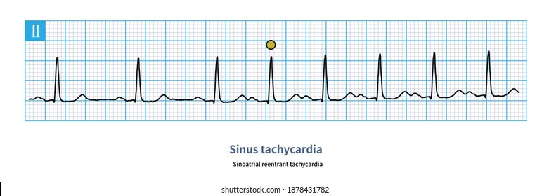 When Reentry Occurs Between The Sinus Node And The Atria, Reentrant Tachycardia Will Be Formed Between The Two. The Essence Is Atrial Tachycardia.