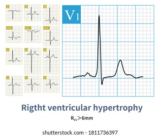 When Right Ventricular Hypertrophy Occurs, The R Wave Amplitude In Lead V1 Increases.