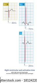 When Right Ventricular Hypertrophy, The Time Of Wall Activation In Right Chest Leads Is Prolonged.