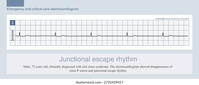 When sinus arrest or third degree sinoatrial block occurs, the timely appearance of escape beats or escape rhythms can prevent excessively slow ventricular rates and avoid amaurosis or syncope.