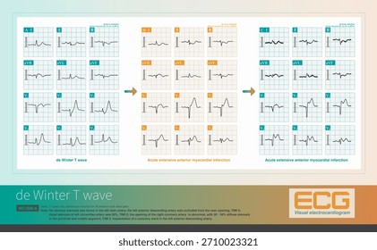 When the ST segment of the de Winter T wave changes from depressed to elevated, it indicates progression to acute AMI, with myocardial ischemia spreading from subendocardial to epicardial.