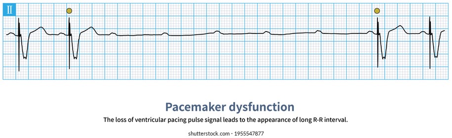When ventricular pacing dysfunction occurs, ventricular pacing pulse signal is lost, long R-R interval appears in ECG, and ventricular rate is too slow or cardiac arrest occurs.