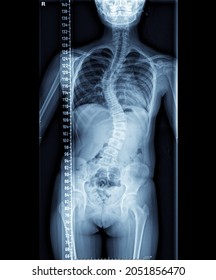 Whole Spine X-ray Showing A Patient With Adolescent Idiopathic Scoliosis Before Correction Deformity Surgery.