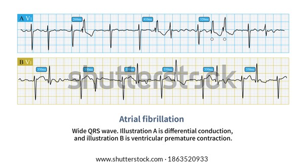 Wide Qrs Complex Atrial Fibrillation Needs Stock Illustration ...