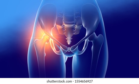 Woman With Arthritic Hip Joints And Skeleton, Medically 3D Illustration On Blue Background