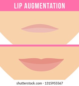 Woman makes procedure of beauty injection for lip augmentation. Lips before and after hyaluronic acid lip filler injection. 