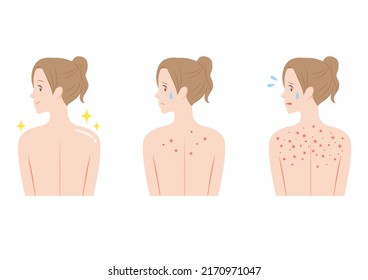 Woman Suffering From Back Acne