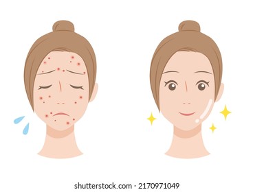 1,189 Acne vulgaris Images, Stock Photos & Vectors | Shutterstock