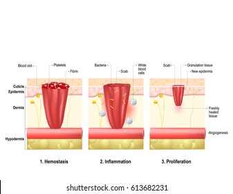 Wound Healing. Process In Body Tissue Repairs After Trauma. Phases Wound Healing: Hemostasis, Inflammation And Proliferation