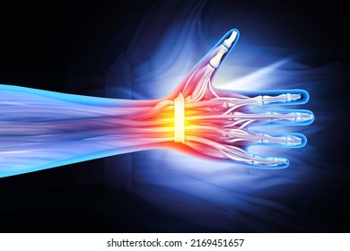 Wrist bones injury, wrist pain, 3d illustration - Powered by Shutterstock