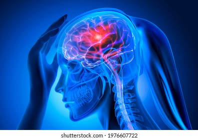 X- Ray Female Head With Brain Stroke  - 3d Illustration