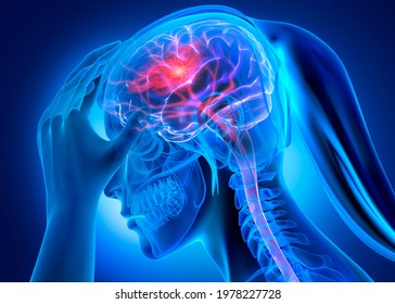 X- Ray female head with brain stroke  - 3d Illustration