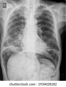 X Ray Images Of Human Chest