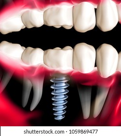 X Ray View Of Denture With Implant. Xray View.3d Rendering