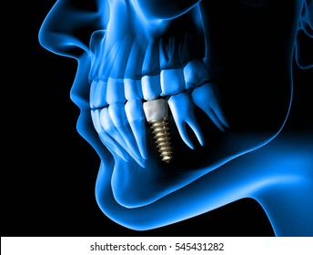 X Ray View Of Denture With Implant. Xray View.3d Rendering