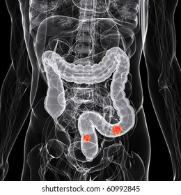 x-ray - anatomy illustration - colon cancer