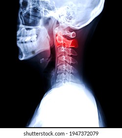 X-ray C-spine Or X-ray Image Of Cervical Spine Lateral View For Diagnostic Intervertebral Disc Herniation And Spondylosis.
