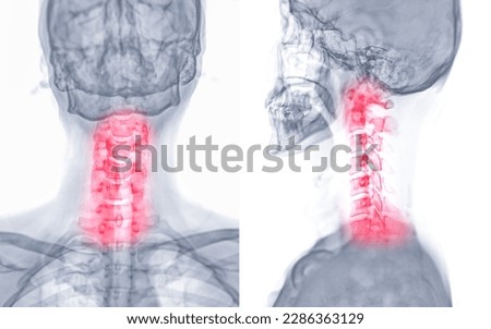 X-ray C-spine or x-ray image of Cervical spine AP and Lateral view for diagnostic intervertebral disc herniation ,Spondylosis and fracture. Stockfoto © 