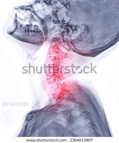 X-ray C-spine or x-ray image of Cervical spine  Extension viewfor diagnostic intervertebral disc herniation ,Spondylosis and fracture. Stockfoto © 