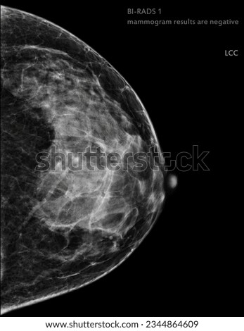  X-ray Digital Mammogram Right side CC view . mammography or breast scan for Breast cancer BI-RADS 1 mammogram results are negative.