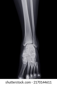 X-ray Image Of Ankle Joint For Diagnosis Fracture Tibia And Fibula Bone.